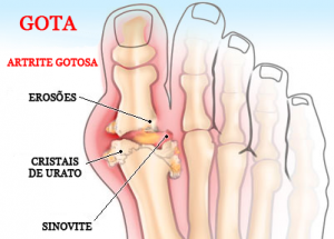 ácido úrico e gota