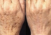 Receita natural para eliminar manchas que aparecem com a idade manchas-de-idade