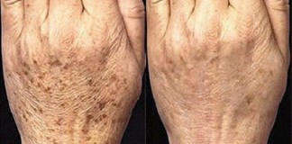 Receita natural para eliminar manchas que aparecem com a idade manchas-de-idade